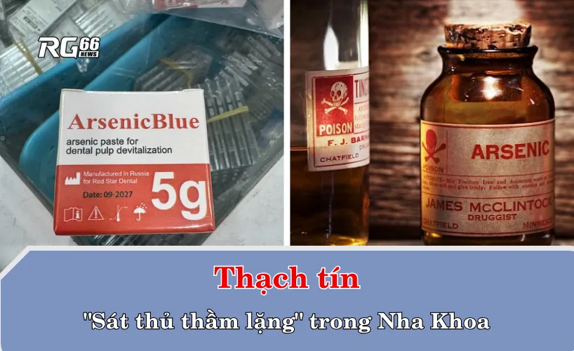 Thạch tín – "Sát thủ thầm lặng" trong Nha Khoa